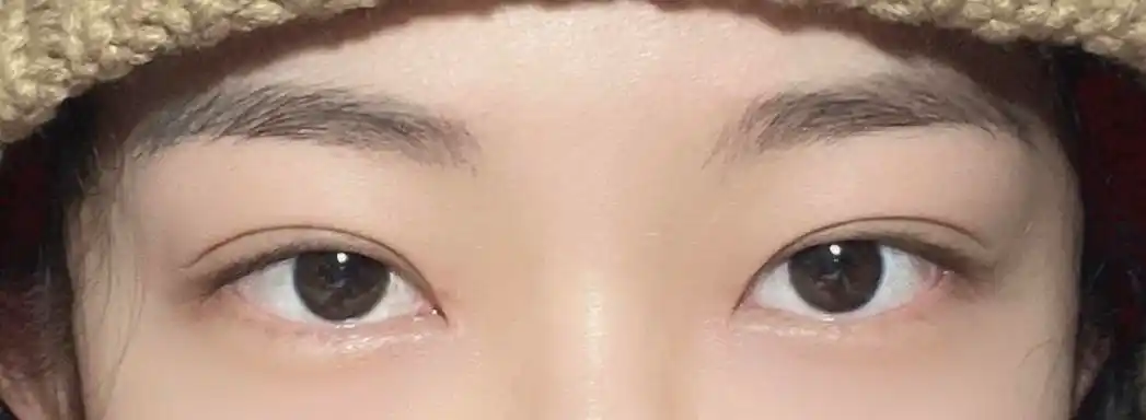 术后恢复贴内双肿泡眼严重内眦赘皮全切开内眼角930手术