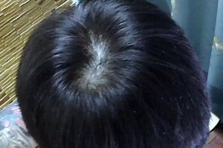 溢脂性脱发的图片