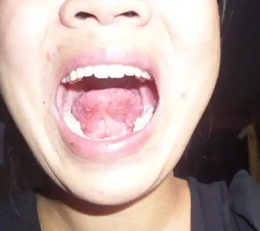 你好 舌头下面长了20多个溃疡 感冒后就开始长了 是不是身体缺少什么?