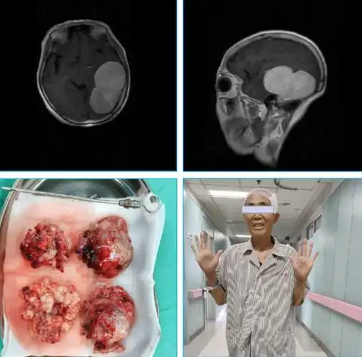 哈医大一院神经外科专家成功切除经线92cm罕见巨大脑膜瘤