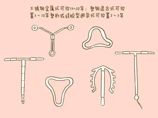 女性产后避孕装的节育环是什么样的有图片吗