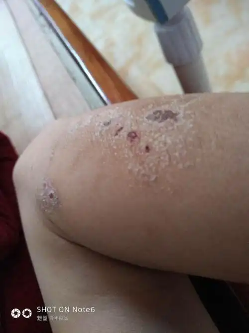 皮肤起皱,干干的,一抠皮就掉.