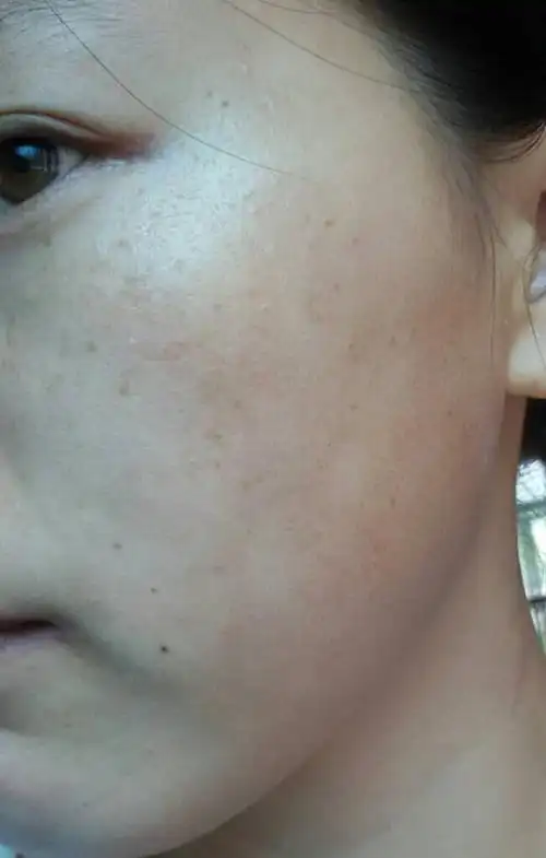 脸颊两侧有一块一块白色的,不疼不痒,也没有皮屑