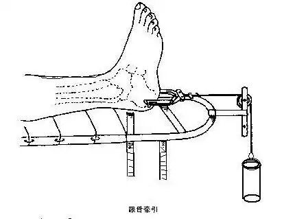 骨牵引术非常实用