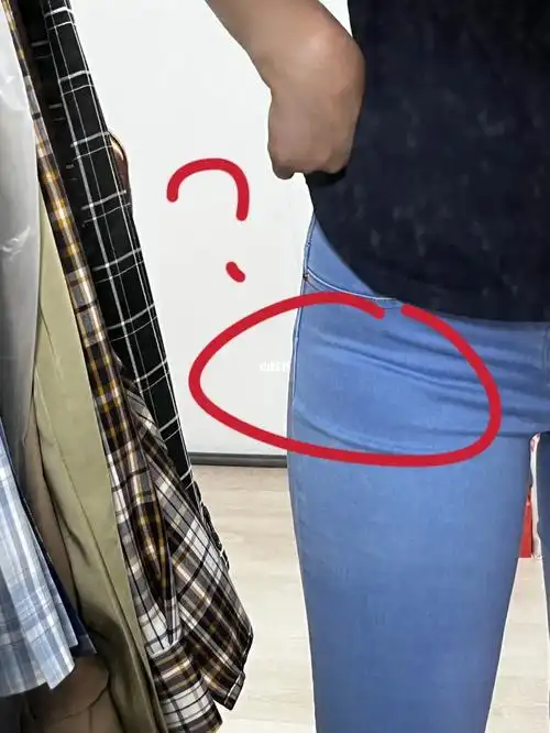 我跟刘畊宏直播跳操一个多月,胯瘦了好多,为啥左大腿根这里有一块肉凸