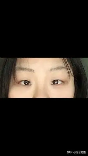 斗鸡眼(即对眼)除了手术治疗还有哪些方法?