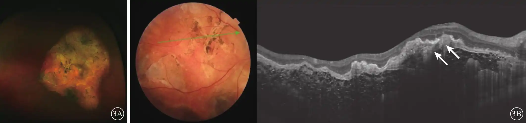 脉络膜骨瘤扫频源光相干断层扫描影像特征