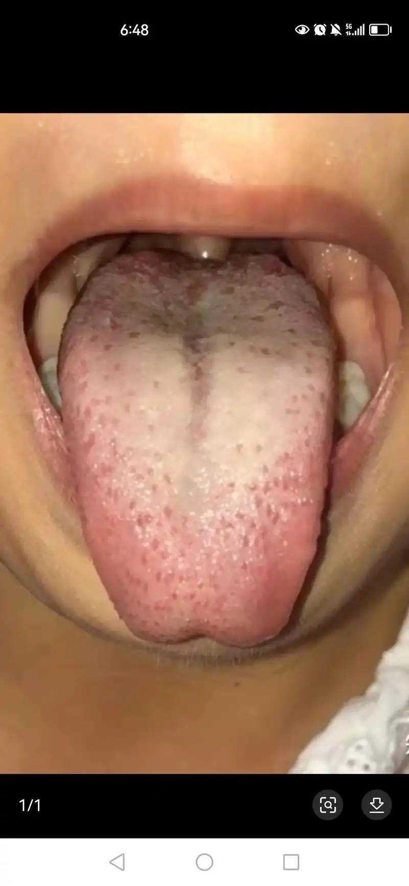 小儿积食常见舌苔.小儿积食常表现为食欲下降,口臭,面色发黄, - 抖音