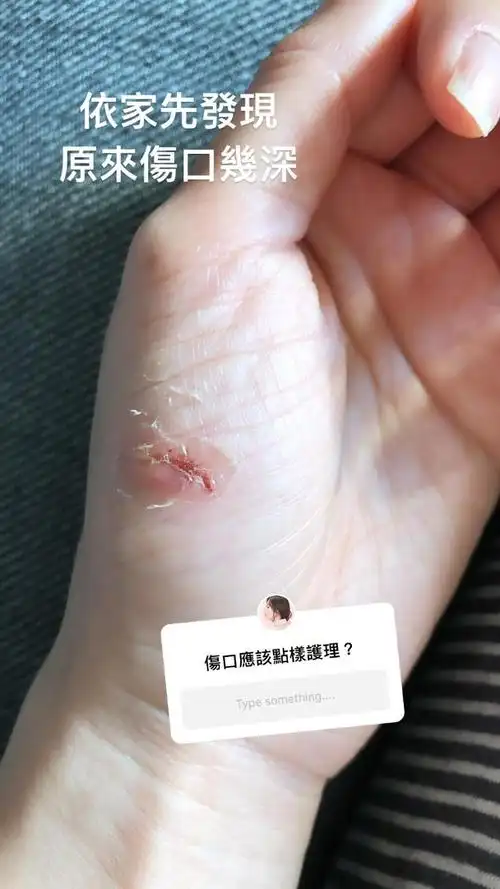 唐诗咏拍新剧手掌受伤伤口深见肉让人心疼