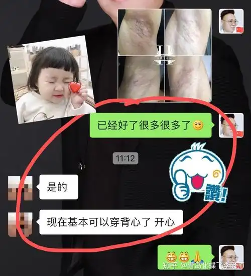 腋下疤痕好了,终于圆了吊带梦