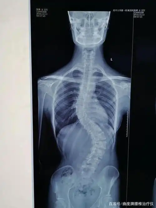 腰椎间盘竟引起脊椎侧弯,该怎么治!