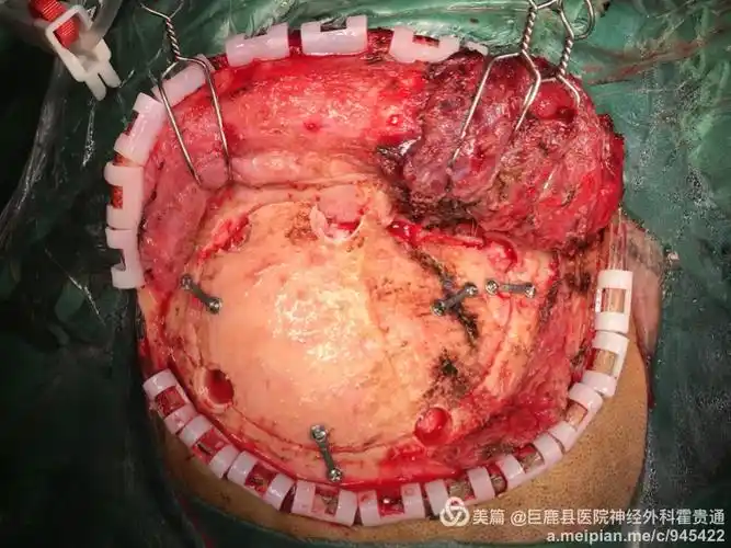 右侧额颞瓣开颅. 术前给颅内压监测,测量手术过程