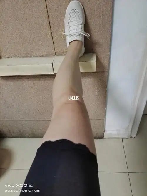 小腿变形典型的xo腿型