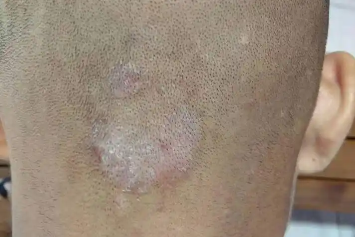 头皮上有散在的白色鳞屑斑片,拇指大或钱币大,其上毛发在头皮上折断