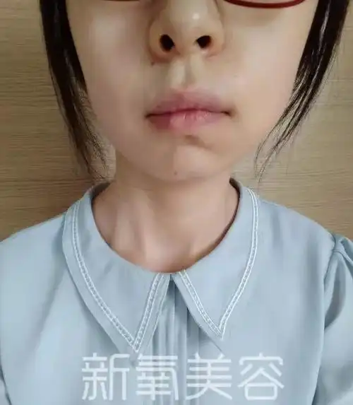 不仅郭碧婷脸歪这些经典明星脸也歪了