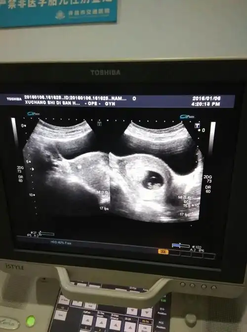 我二胎想要女儿 但症状和儿子的比较像 孕囊形状茄子型 不厌吃肉…顺