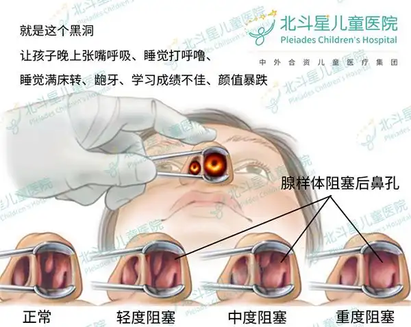 儿童扁桃体肥大腺样体肥大