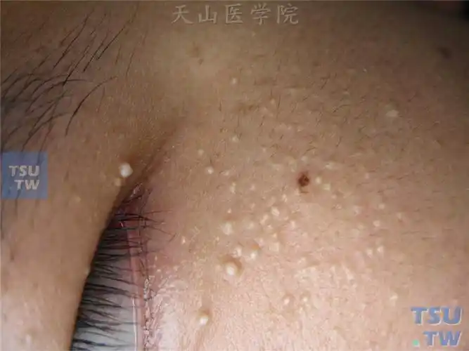 良性肿瘤粟丘疹milia症状表现