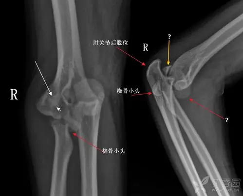 肘关节骨折伴脱位