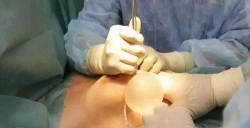 震撼实拍国外美女隆胸手术全过程