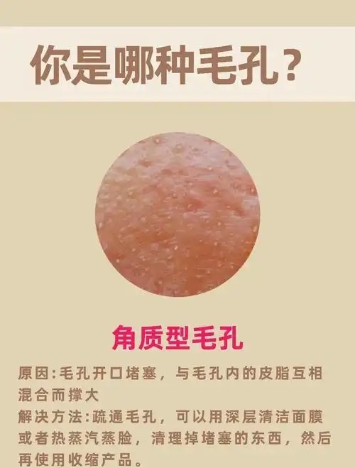 四种毛孔粗大类型,你是哪一种?