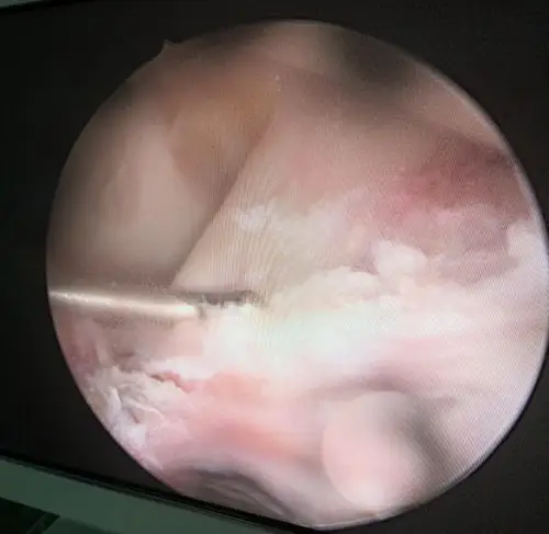 胫骨髁间棘撕脱骨折关节镜下固定一例