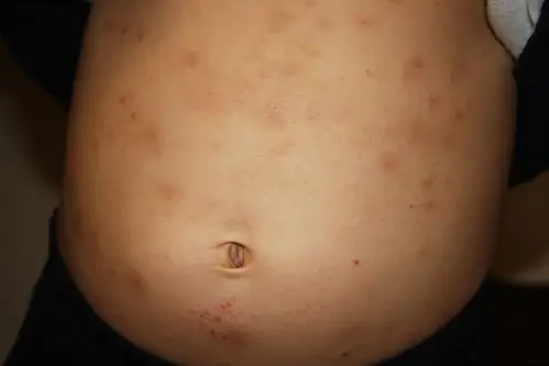 清热凉血法治疗儿童湿疹