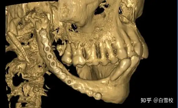 下颌骨弥漫硬化性骨髓炎——一种特殊类型骨髓炎的发现记