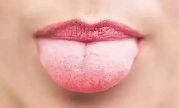 中医舌头诊断图,看舌头懂健康,收藏备用! - 知乎