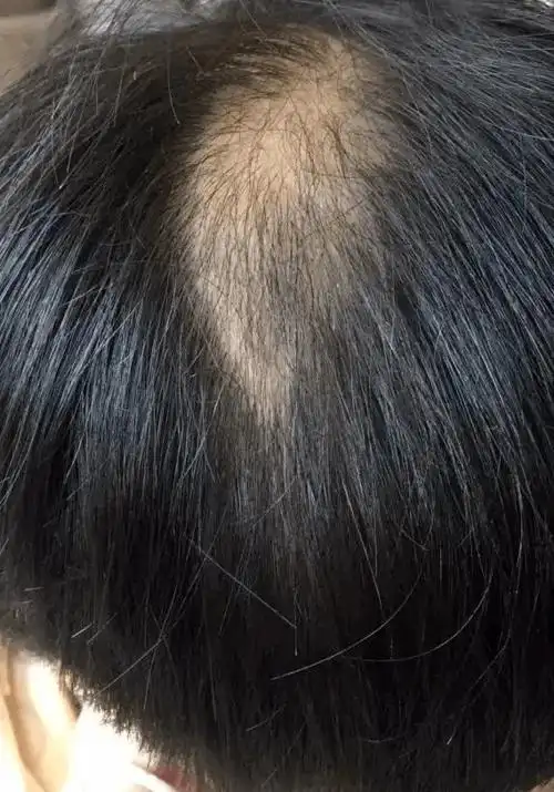 10后也开始秃了俩小学女生不断脱发得知真相父母后悔不已