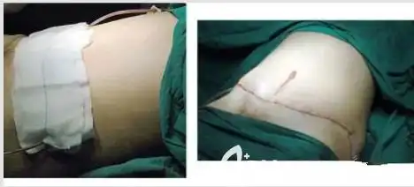 产后减肥后皮肤松弛下垂不妨来看看腹壁成形术切掉的肉简直惊呆了