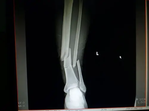 三例 胫腓骨远端骨折 - 骨科与显微外科专业讨论版 - 爱爱医医学论坛