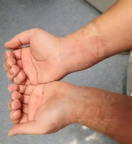 面部及手臂被压出勒痕