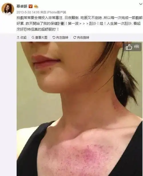 被阿娇刮痧照片吓到了吗?其实明星更喜欢拔罐,连欧美大腕也做!