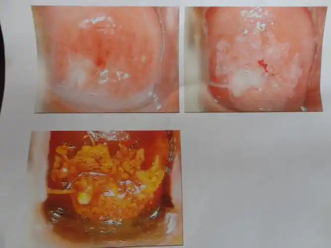 宫颈糜烂的治疗方法