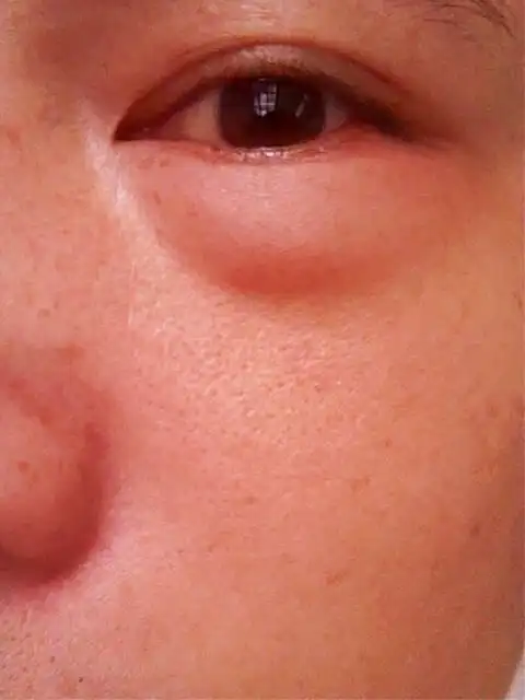 下眼脸肿了,这是什么病?要用什么药?