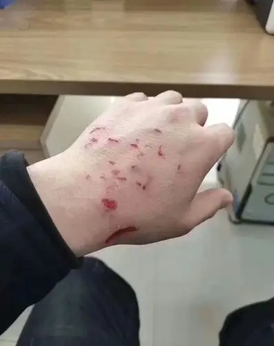 张家口4路公交车乘客把交管人员手背抓的伤痕累累!