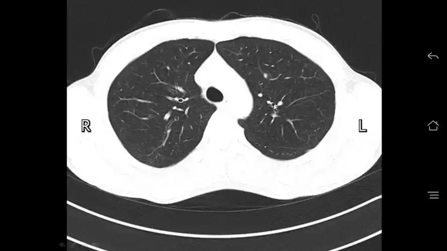 肺ct