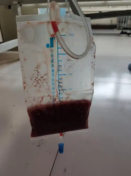 超声引导下胸腔积液经皮穿刺置管引流术