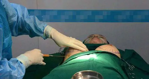 隆胸手术 (16)_有来医生