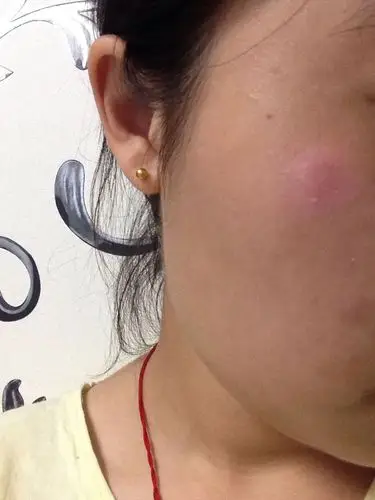 问:脸上起了一小块癣 一开始很痒 然后会爆皮 现在不痒了 但是还能