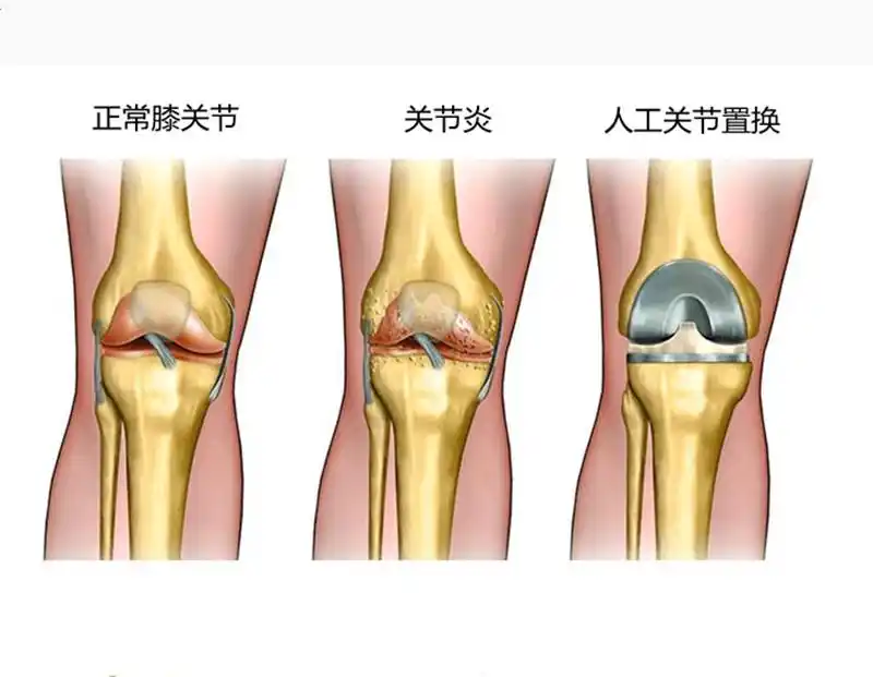 人工膝关节置换手术,哪些人会不满意?来看一份调查报告