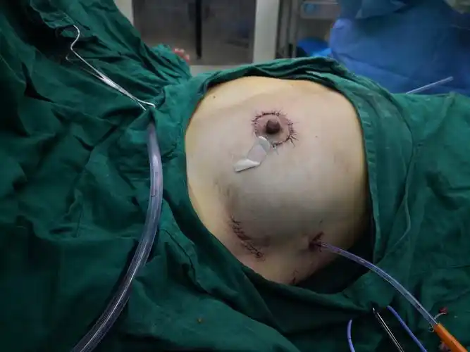 这是近期完成的一例乳腺癌保乳手术,选择的是双环切口,做完后在乳房