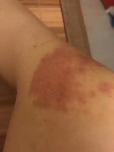 膝盖积液的并发症