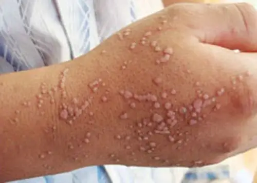 丝状疣的对比图片