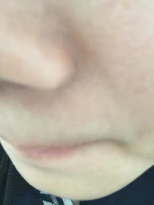 求助,鼻翼两侧发黑