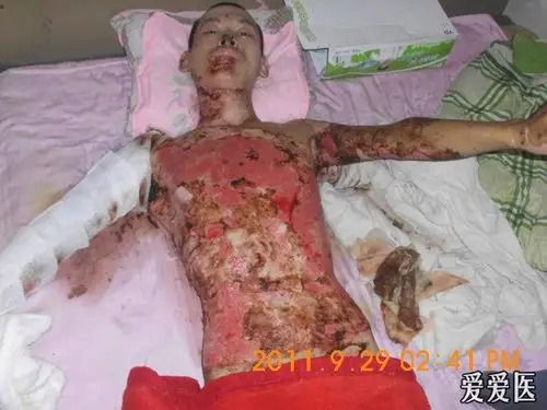 较大面积烧伤病人的保守治疗