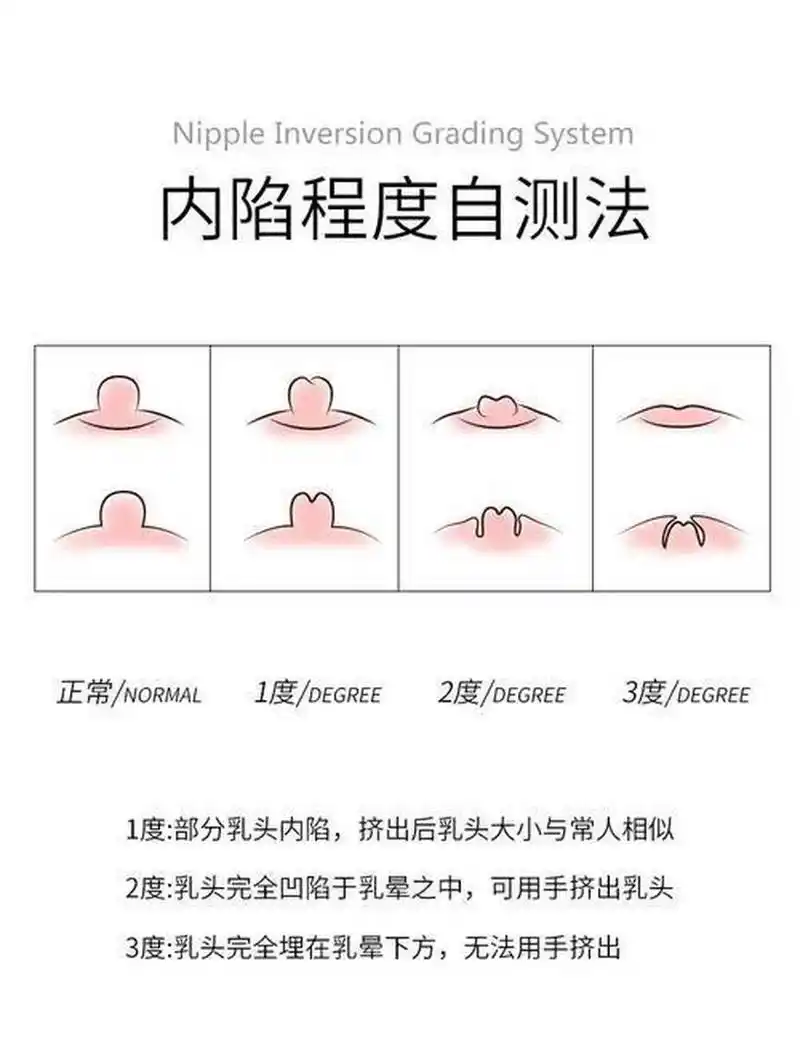 内陷是一种常见的乳房问题,患者的乳头向内缩进,出现隆起或凹陷的现象
