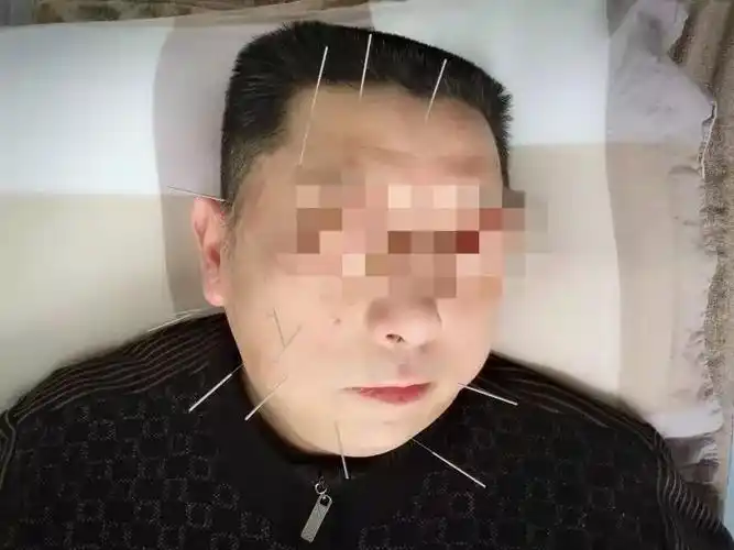 每周学一穴治面瘫又美容的穴位你知道吗