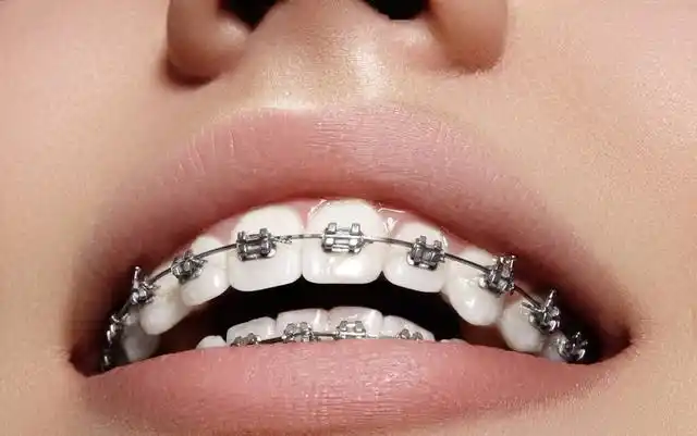 有效的生理性支抗矫治技术对正畸治疗尤为关键,备受正畸医生关注